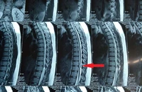 Phẫu thuật thành công cho bệnh nhân u tủy sống ngực