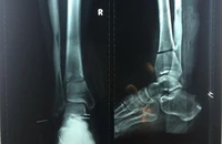 Bất cẩn suýt mất bàn chân vì máy cắt cỏ