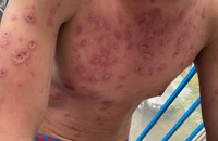 Tưởng dị ứng thuốc, té ra mắc hội chứng hiếm gặp ở nam giới