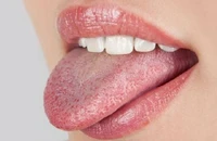 Lưỡi nổi mụn nhỏ, đau rát, phải làm sao bác sĩ ơi?