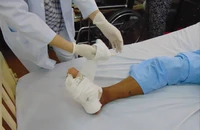 25% bệnh nhân đái tháo đường có biến chứng loét bàn chân