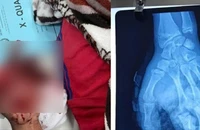 Đêm giao thừa, bé trai 14 tuổi đốt pháo tự chế bị giập nát bàn tay