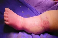 Bố mẹ đắp lá chữa bỏng nước sôi khiến bé 9 tháng tử vong