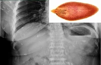 Đau thắt lưng, đi khám ra sán lá gan lớn sinh sôi khắp cơ thể 