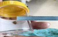 Khám sức khỏe vô tình phát hiện xương gà đâm ruột 