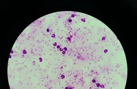 TP.HCM: Hai người trở về từ Châu Phi mang theo virus sốt rét ác tính