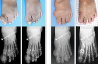 Nhiều bệnh nhân gút biến chứng phục hồi nhờ mô hình này