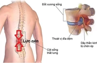 Điều trị thoát vị đĩa đệm bằng kỹ thuật hiệu chỉnh cơ xương khớp