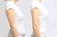 Gù lưng, lệch vai có thể chỉnh dáng được không?