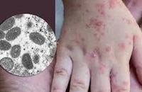 Sau Đồng Nai, Bình Dương ghi nhận người đầu tiên mắc đậu mùa khỉ
