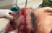 Đại úy Công an ở Bình Phước bị kẻ gây rối chém trọng thương 