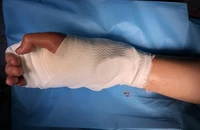 Nối bàn tay bị chém đứt lìa không cần chỉ khâu cho thiếu niên 17 tuổi