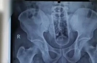 Phẫu thuật cấp cứu lấy chai nhựa dài 20cm trong hậu môn người đàn ông