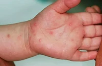 TP.HCM cảnh báo tác nhân EV71 gây bệnh tay chân miệng nặng xuất hiện trở lại