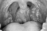 Coi chừng viêm họng có thể dẫn đến bệnh thấp tim