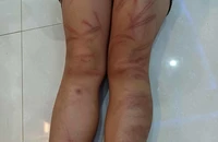 Nhóm học sinh mầm non bị đánh bầm tím, 2 em phải nhập viện