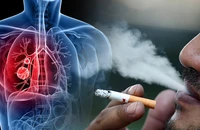 7 yếu tố làm tăng nguy cơ mắc bệnh phổi