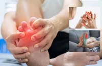 Dấu hiệu cho thấy nồng độ axit uric của bạn đã vượt khỏi tầm kiểm soát