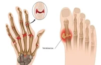 Những dấu hiệu sớm của tình trạng axit uric cao cần chú ý