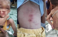 Điều tra vụ bé trai 1 tuổi nghi bị bạo hành, khắp người đầy thương tích