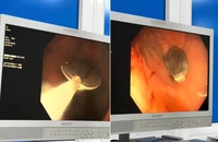 Bé trai 11 tuổi nuốt nắp lon nước ngọt vào dạ dày