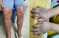 Cảnh báo biến chứng thận nguy hiểm do ban xuất huyết Schonlein- Henoch ở trẻ em