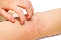 Cách chăm sóc đúng cho người bị viêm da cơ địa