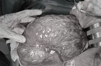 Đi khám đau bụng, người phụ nữ phải phẫu thuật cắt bỏ khối u gần 3,5 kg 