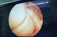 Rách sụn chêm dạng quai xách khi đá banh, đừng chủ quan!