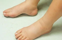 2 trẻ nhập viện vì phù bất thường, phát hiện viêm cầu thận cấp