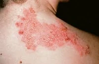 Zona thần kinh, 'ngòi nổ' cho nhiều biến chứng nguy hiểm