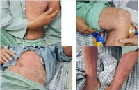 Nhiễm khuẩn máu nguy kịch sau khi mổ lợn 1 tuần