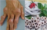 Người bệnh gút nên và không nên ăn gì? 