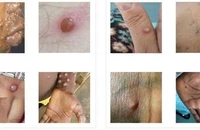 4 giai đoạn từ nhẹ đến nặng của bệnh đậu mùa khỉ 