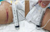 Sức khỏe hiện tại của bé gái 18 tháng tuổi nghi bị bạo hành tại Hà Nội 