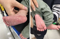 Bé 46 ngày tuổi bị giang mai 