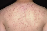 Đến spa tẩy mụn trứng cá ở lưng, người phụ nữ suýt mất mạng 