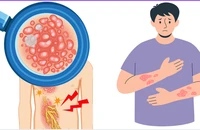 Vì sao người trên 50 tuổi có bệnh nền dễ gặp biến chứng do zona?