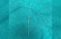 Tìm thấy giun 12 cm từ má của người phụ nữ bị muỗi đốt