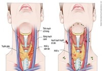 Cách nhận biết sớm triệu chứng ung thư vòm họng