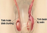 Những bệnh lý nguy hiểm ở tinh hoàn