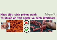 Phân biệt bệnh do ‘vi khuẩn ăn thịt người’ và bệnh whitmore