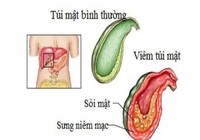 Viêm túi mật: Chủ quan là nguy