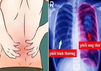 Ðau lưng phía sau phổi có phải dấu hiệu ung thư?