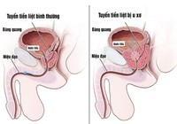 Dấu hiệu u xơ tuyến tiền liệt