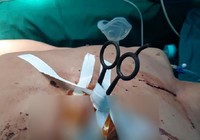 Bất cẩn, người đàn ông bị kéo đâm thủng màng tim