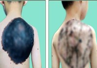 U hắc tố khổng lồ 'ăn' gần hết lưng bé trai