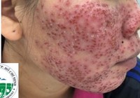 Mặt tiền tan nát, vỡ mộng trắng sáng vì lột da bằng hóa chất