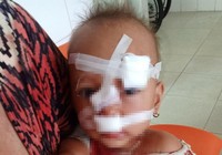 Cha mẹ cãi nhau, bé gái hai tuổi nhập viện khâu 12 mũi