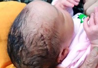 Mổ đẻ, bác sĩ đụng dao làm rách da đầu bé sơ sinh